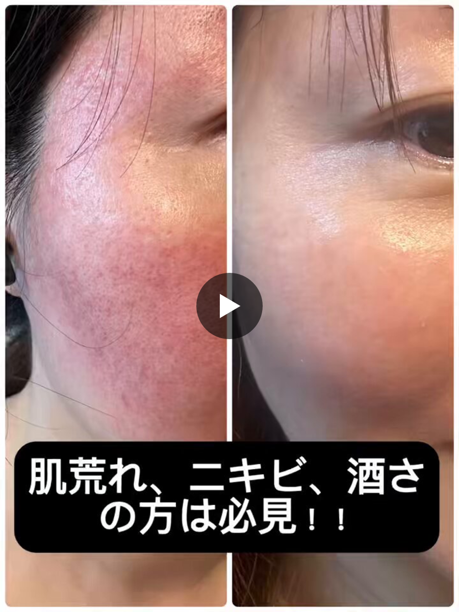 プラズマ美顔器のUn（アン）／公式 on X: 