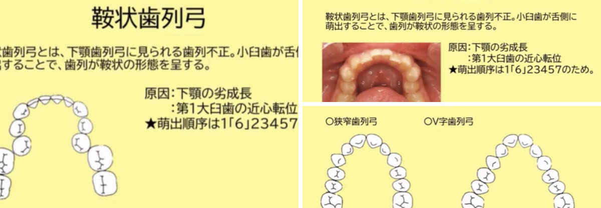歯科医師国家試験対策 ロムニーハウス勉強会【講師 Dr.N】 on X: 